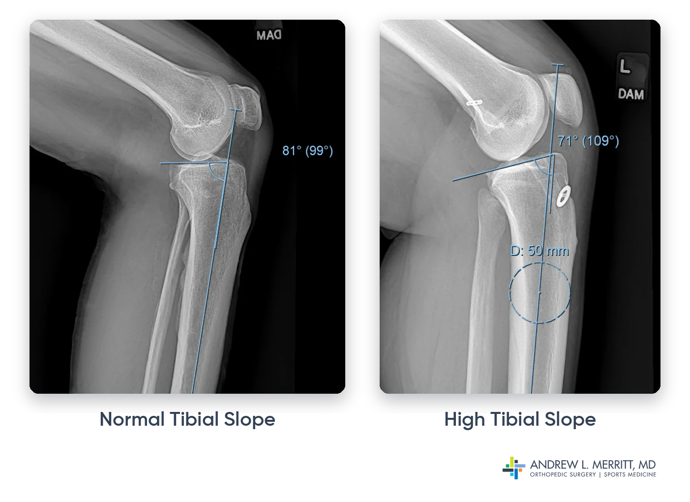 Side-view knee X-rays comparing a normal tibial slope with a high tibial slope, a risk factor for ACL graft failure