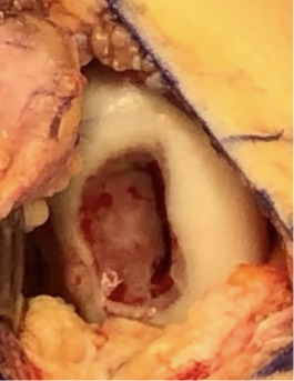 Open view of a large, deep OCD defect in the femoral condyle